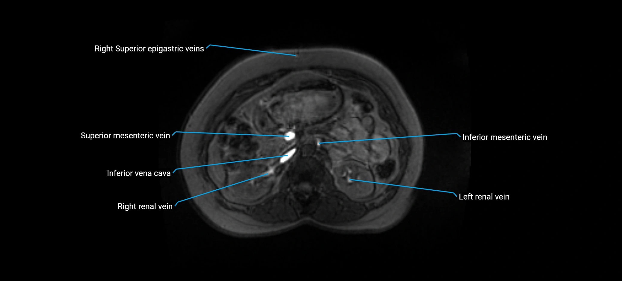 MRV abdomen pelvis & lower limb axial cross sectional anatomy labelled MRI image 69 (1).webp